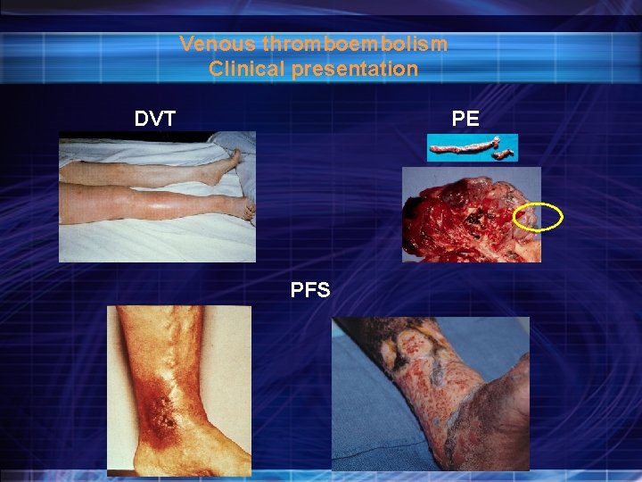 Venous thromboembolism Clinical presentation DVT PE PFS 