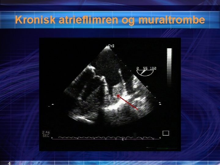 Kronisk atrieflimren og muraltrombe 4 