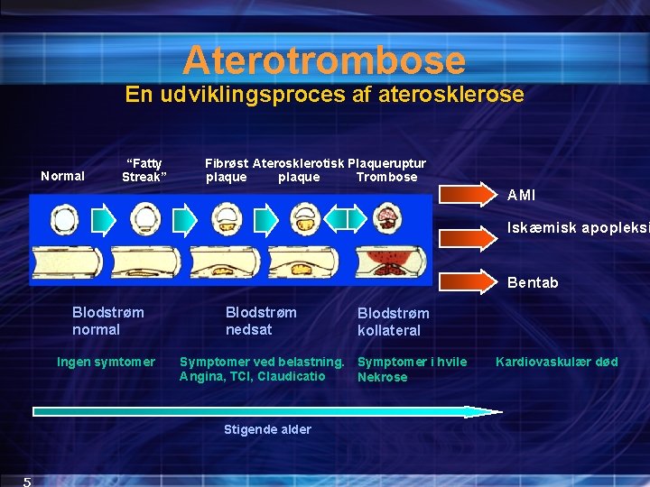 Aterotrombose En udviklingsproces af aterosklerose Normal “Fatty Streak” Fibrøst Aterosklerotisk Plaqueruptur plaque Trombose AMI