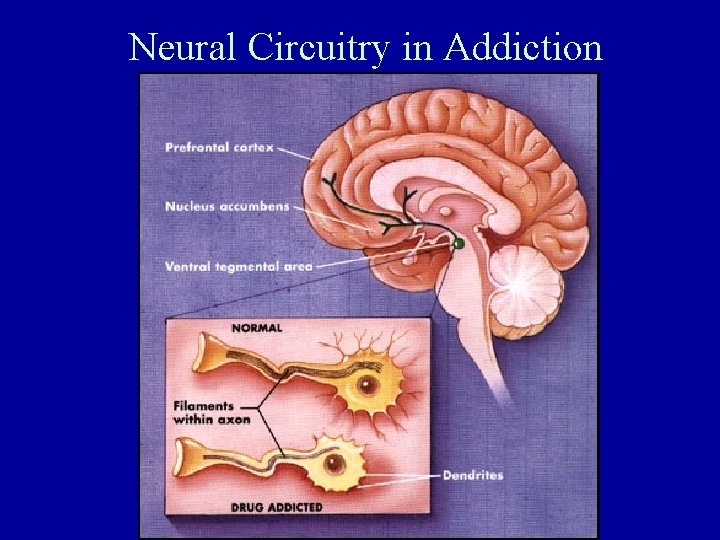 Neural Circuitry in Addiction 