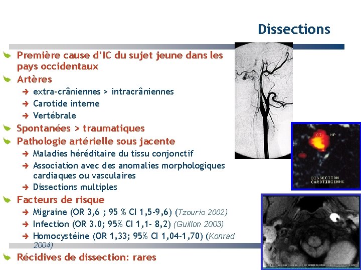 Dissections Première cause d’IC du sujet jeune dans les pays occidentaux Artères extra-crâniennes >