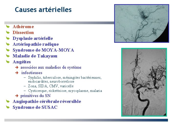 Causes artérielles Athérome Dissection Dysplasie artérielle Artériopathie radique Syndrome de MOYA-MOYA Maladie de Takayasu