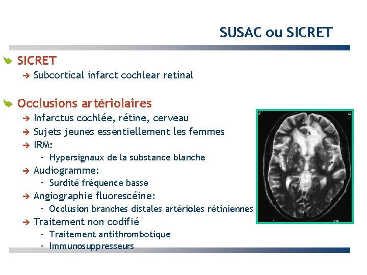 SUSAC ou SICRET Subcortical infarct cochlear retinal Occlusions artériolaires Infarctus cochlée, rétine, cerveau Sujets