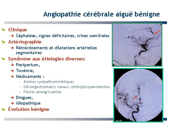 Angiopathie cérébrale aiguë bénigne Clinique Céphalées, signes déficitaires, crises comitiales Artériographie Rétrécissements et dilatations