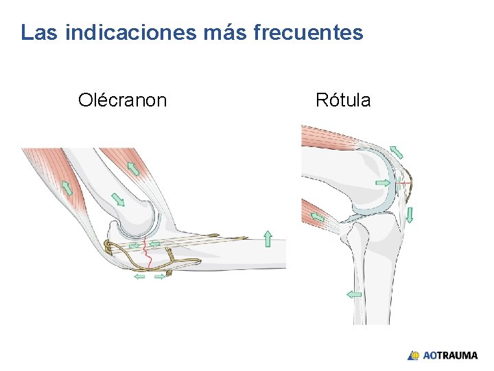 Las indicaciones más frecuentes Olécranon Rótula 