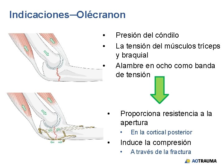 Indicaciones─Olécranon • • Presión del cóndilo La tensión del músculos tríceps y braquial Alambre