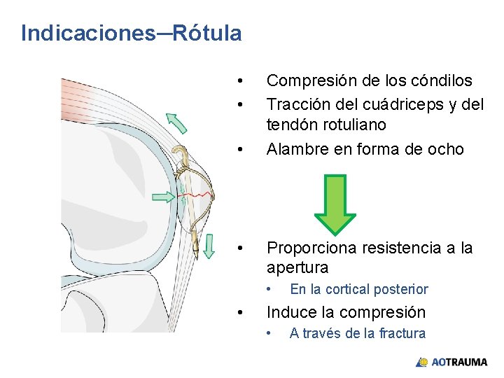 Indicaciones─Rótula • • Compresión de los cóndilos Tracción del cuádriceps y del tendón rotuliano