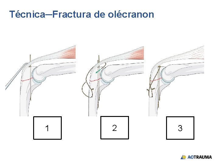 Técnica─Fractura de olécranon 1 2 3 