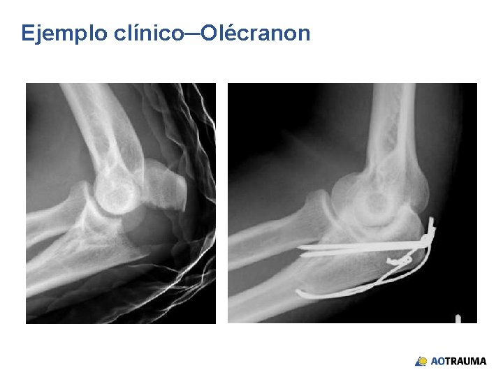 Ejemplo clínico─Olécranon 