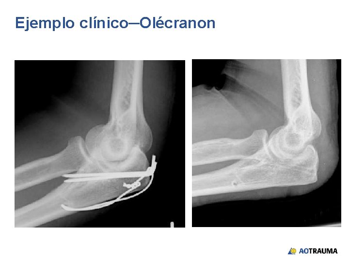 Ejemplo clínico─Olécranon 