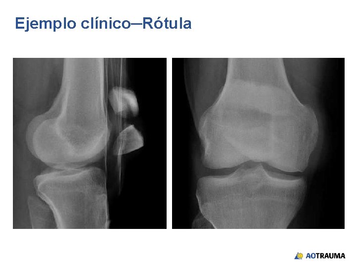 Ejemplo clínico─Rótula 