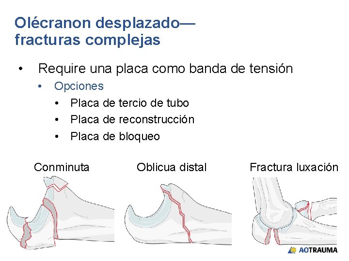 Olécranon desplazado— fracturas complejas • Require una placa como banda de tensión • Opciones