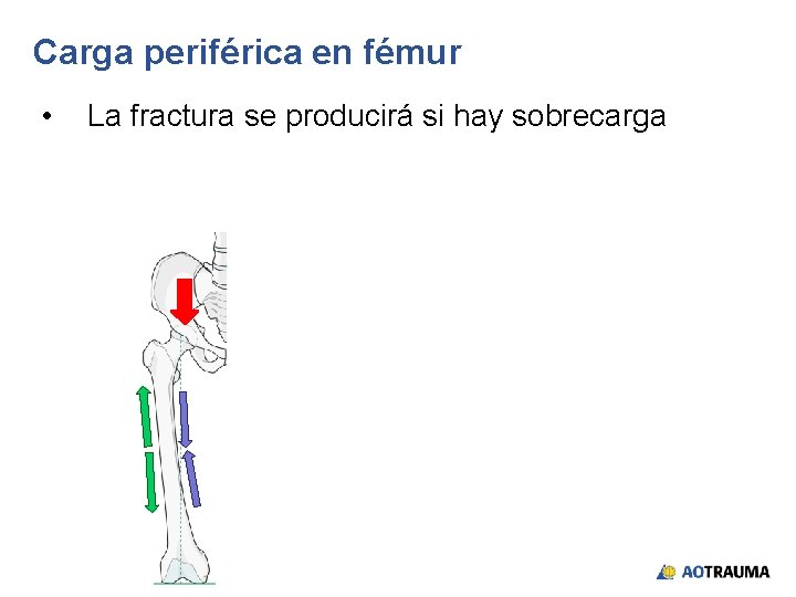 Carga periférica en fémur • La fractura se producirá si hay sobrecarga 