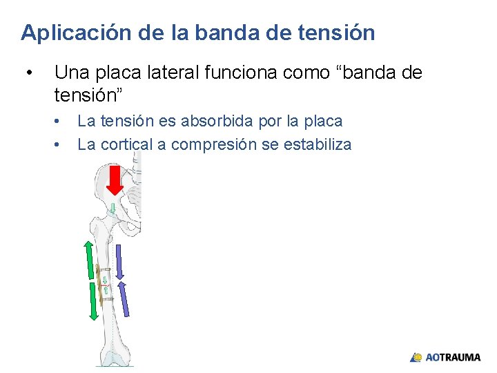 Aplicación de la banda de tensión • Una placa lateral funciona como “banda de