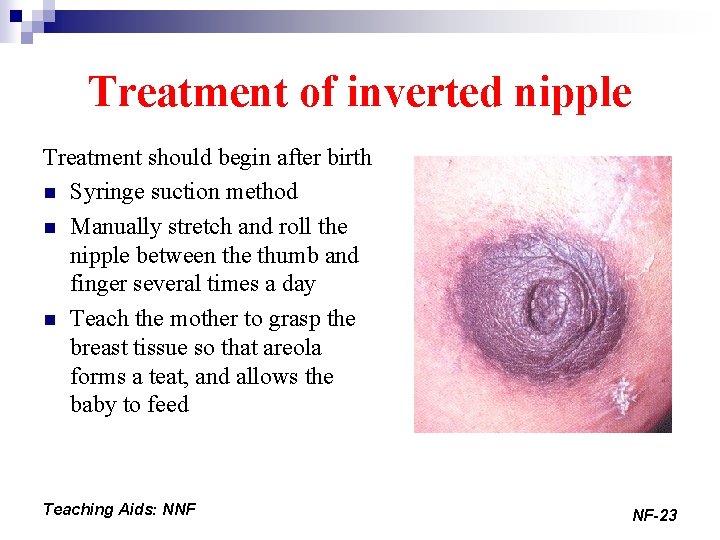 Treatment of inverted nipple Treatment should begin after birth n Syringe suction method n