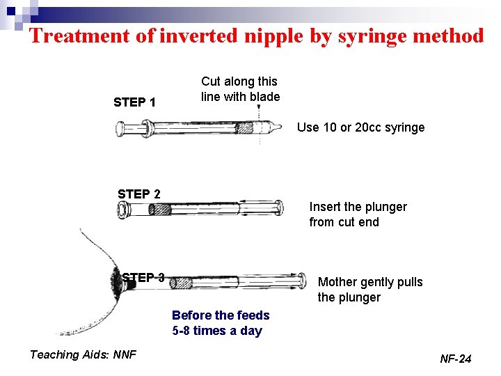 Treatment of inverted nipple by syringe method STEP 1 Cut along this line with