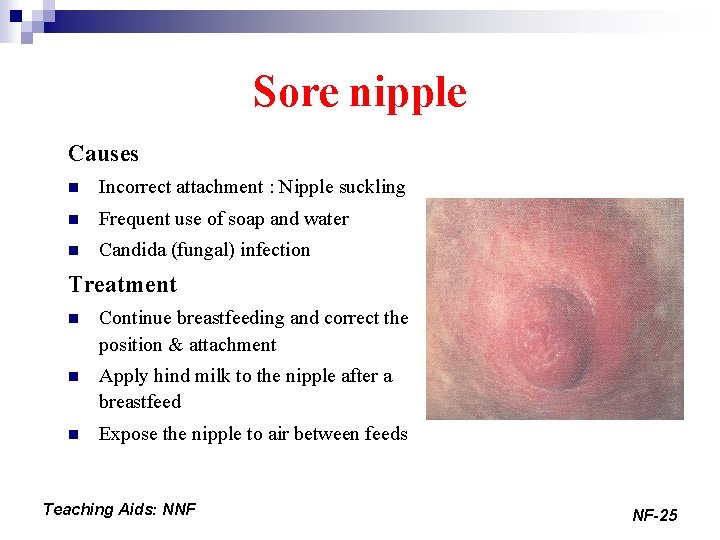 Sore nipple Causes n Incorrect attachment : Nipple suckling n Frequent use of soap