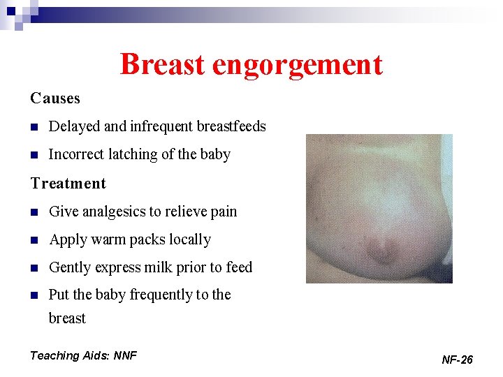 Breast engorgement Causes n Delayed and infrequent breastfeeds n Incorrect latching of the baby