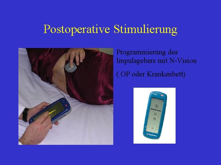 Postoperative Stimulierung Programmierung des Impulsgebers mit N-Vision ( OP oder Krankenbett) 