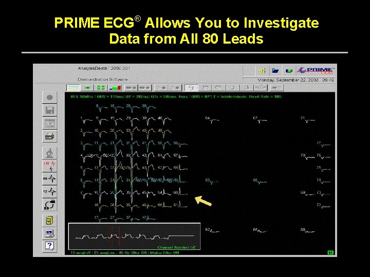 PRIME ECG® Allows You to Investigate Data from All 80 Leads • View a