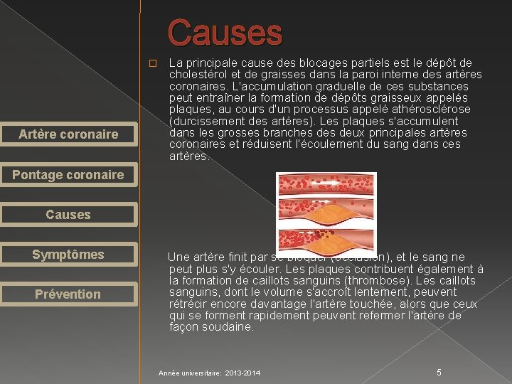 Causes � Artère coronaire La principale cause des blocages partiels est le dépôt de