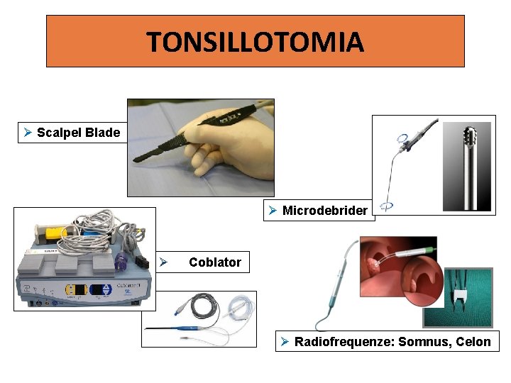 TONSILLOTOMIA Scalpel Blade Microdebrider Coblator Radiofrequenze: Somnus, Celon 