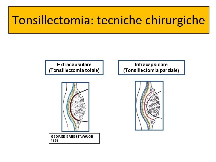 Tonsillectomia: tecniche chirurgiche Extracapsulare (Tonsillectomia totale) GEORGE ERNEST WAUGH 1909 Intracapsulare (Tonsillectomia parziale) 