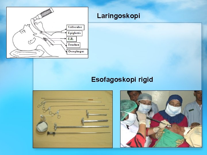 Laringoskopi Esofagoskopi rigid 