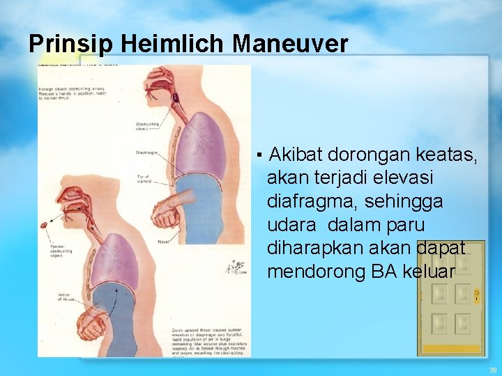 Prinsip Heimlich Maneuver ▪ Akibat dorongan keatas, akan terjadi elevasi diafragma, sehingga udara dalam