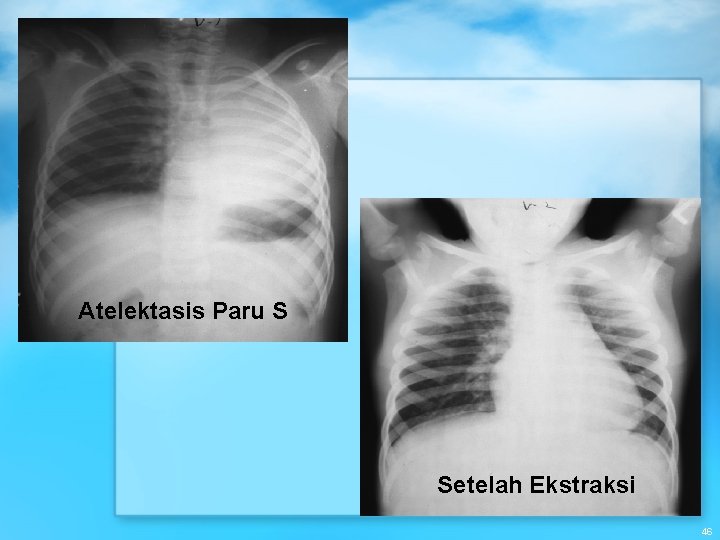 Atelektasis Paru S Setelah Ekstraksi 46 