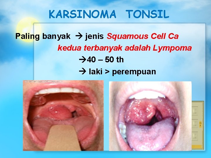 KARSINOMA TONSIL Paling banyak jenis Squamous Cell Ca kedua terbanyak adalah Lympoma 40 –