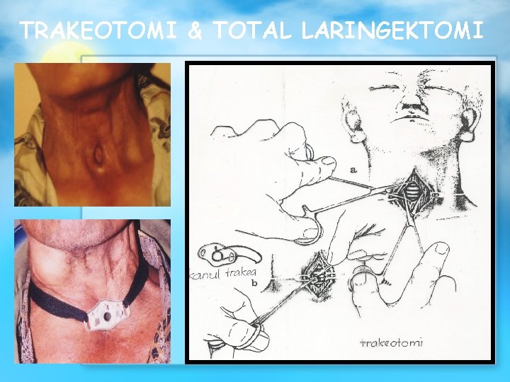 TRAKEOTOMI & TOTAL LARINGEKTOMI 