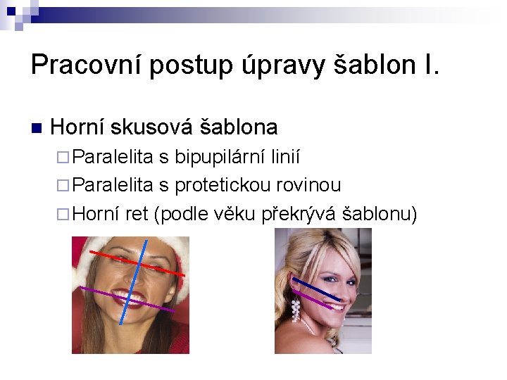 Pracovní postup úpravy šablon I. n Horní skusová šablona ¨ Paralelita s bipupilární linií