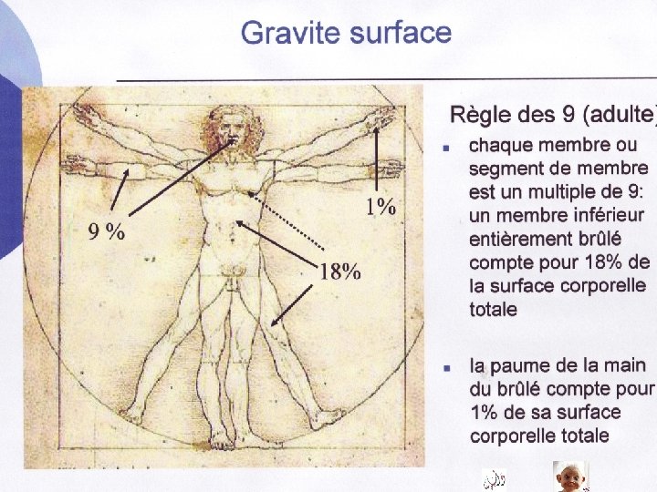 Brûlures : gravité surface Brûlures : gravité surface