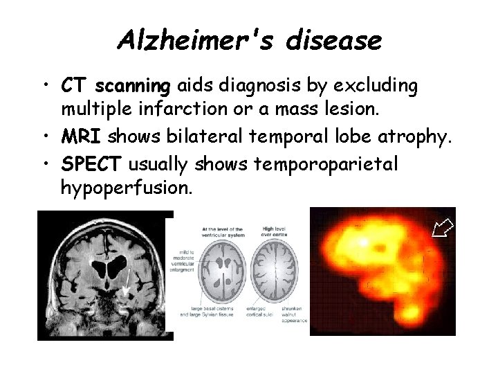 Alzheimer's disease • CT scanning aids diagnosis by excluding multiple infarction or a mass