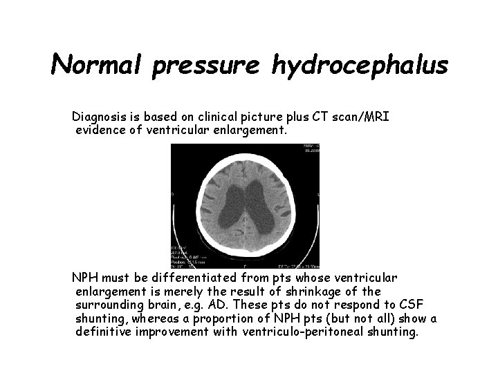 Normal pressure hydrocephalus Diagnosis is based on clinical picture plus CT scan/MRI evidence of