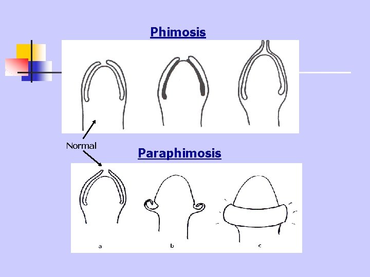 Phimosis Normal Paraphimosis 