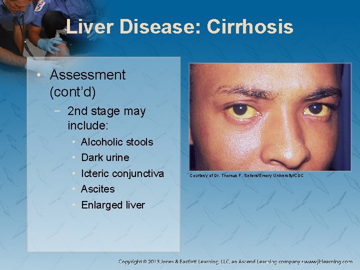 Liver Disease: Cirrhosis • Assessment (cont’d) − 2 nd stage may include: • •