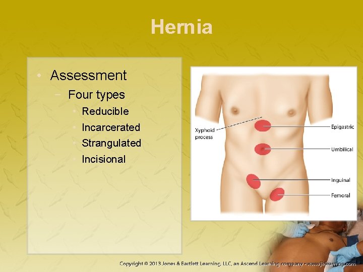 Hernia • Assessment − Four types • • Reducible Incarcerated Strangulated Incisional 
