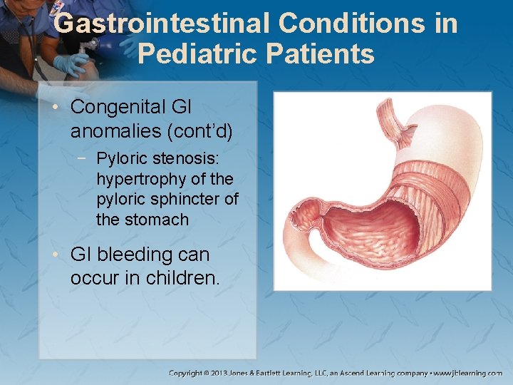 Gastrointestinal Conditions in Pediatric Patients • Congenital GI anomalies (cont’d) − Pyloric stenosis: hypertrophy