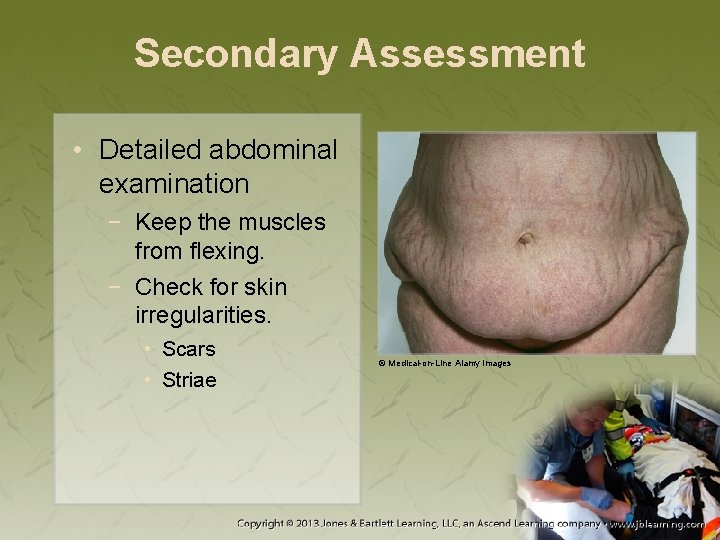 Secondary Assessment • Detailed abdominal examination − Keep the muscles from flexing. − Check
