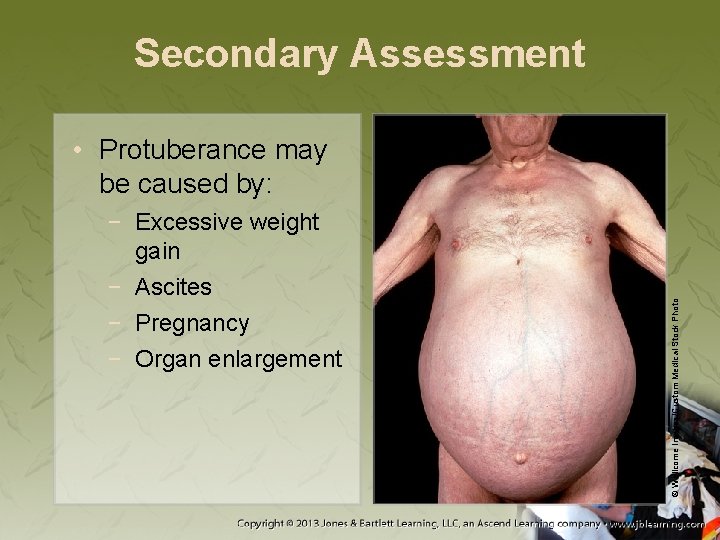 Secondary Assessment − Excessive weight gain − Ascites − Pregnancy − Organ enlargement ©