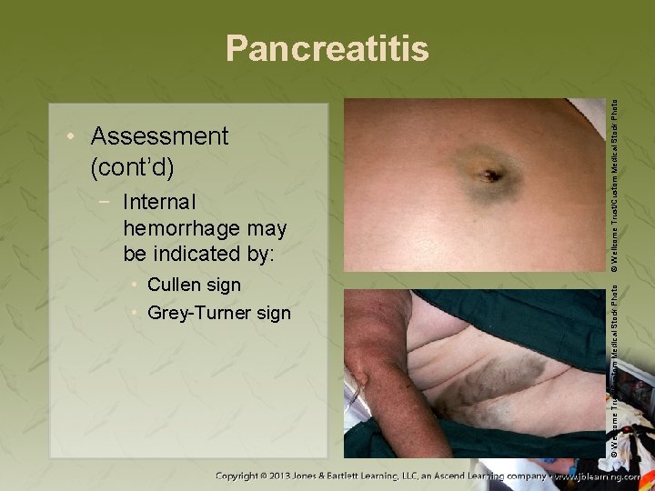 − Internal hemorrhage may be indicated by: • Cullen sign • Grey-Turner sign ©