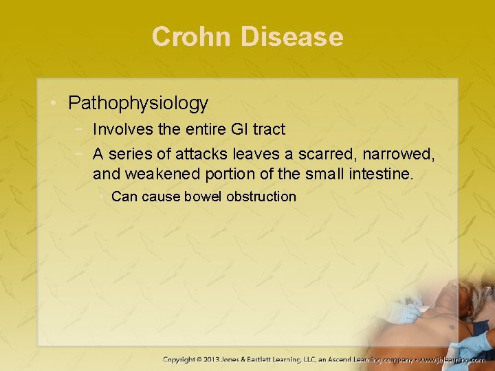 Crohn Disease • Pathophysiology − Involves the entire GI tract − A series of