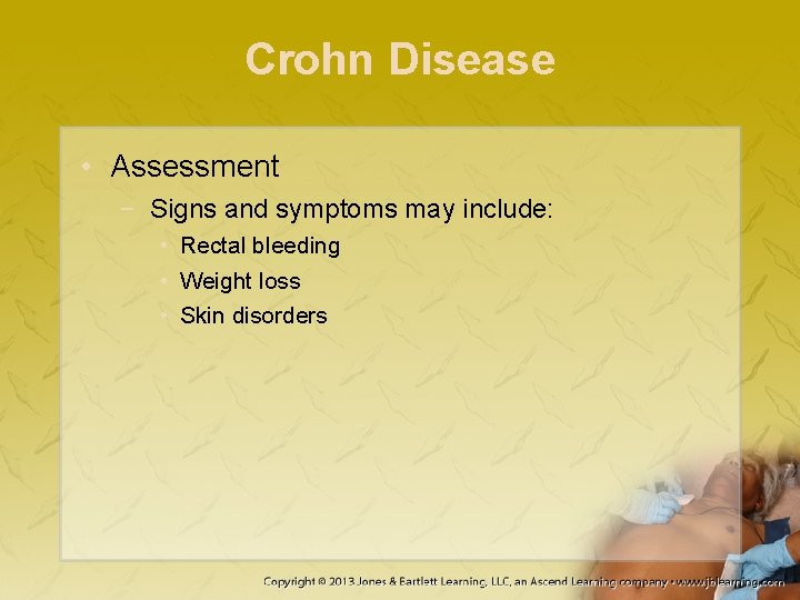 Crohn Disease • Assessment − Signs and symptoms may include: • Rectal bleeding •