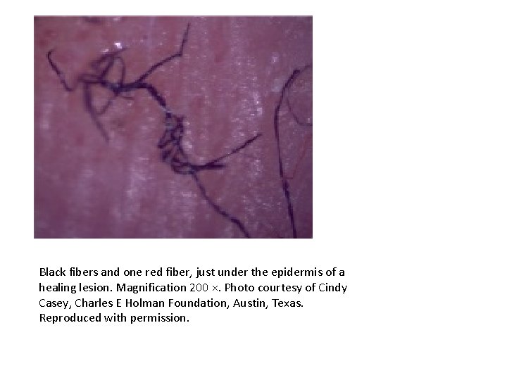 Black fibers and one red fiber, just under the epidermis of a healing lesion.