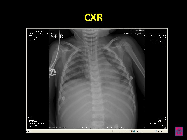 CXR 