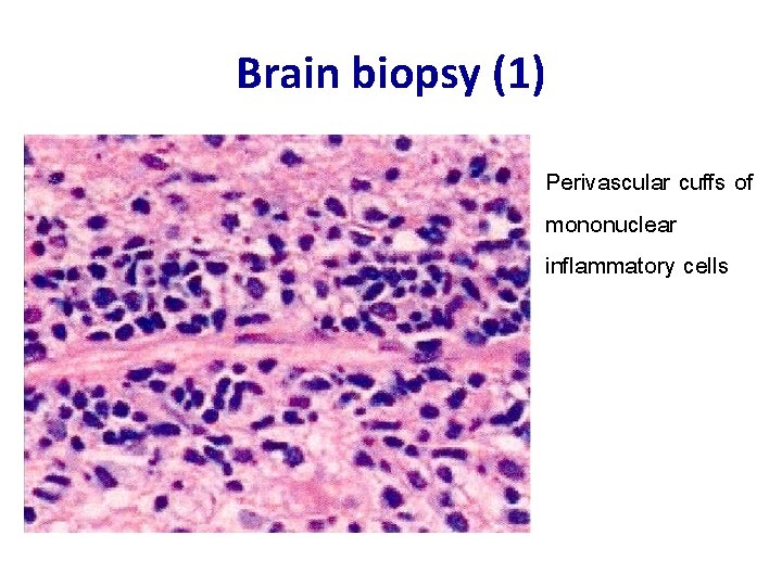 Brain biopsy (1) Perivascular cuffs of mononuclear inflammatory cells 