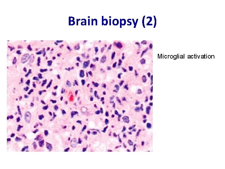 Brain biopsy (2) Microglial activation 