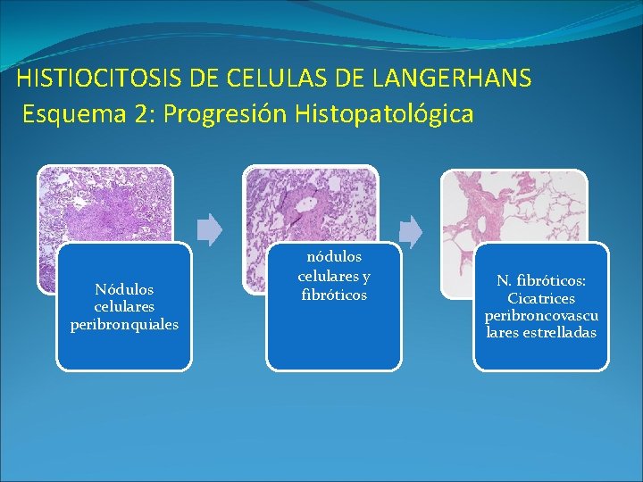 HISTIOCITOSIS DE CELULAS DE LANGERHANS Esquema 2: Progresión Histopatológica Nódulos celulares peribronquiales nódulos celulares